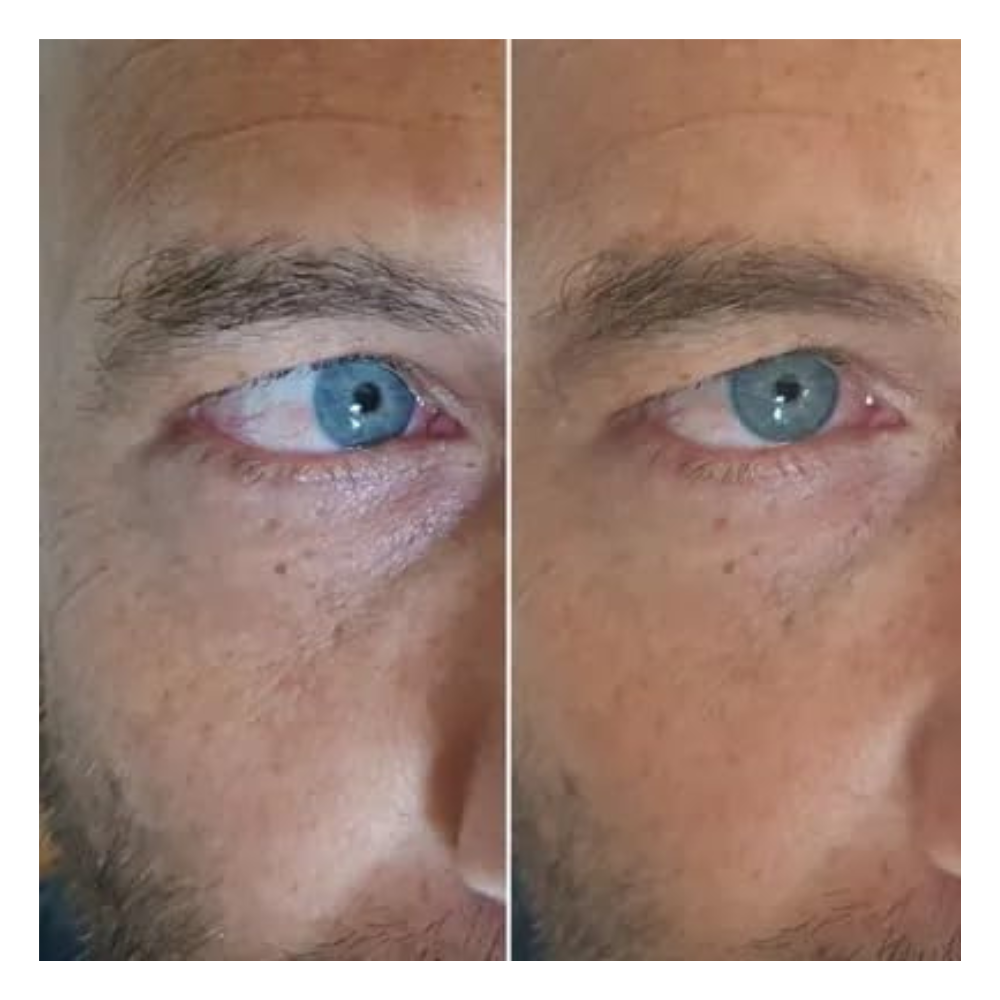 Cryoslices - Skincare Eye Gels Half Moon - Pack of 2